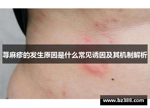 荨麻疹的发生原因是什么常见诱因及其机制解析